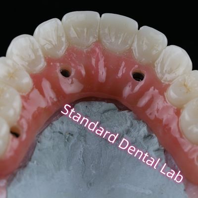 kupować Korona implantów stomatologicznych PFZ Porcelanowa śrubka z warstwą cyrkonii utrzymana z różową gumą produkcja internetowa