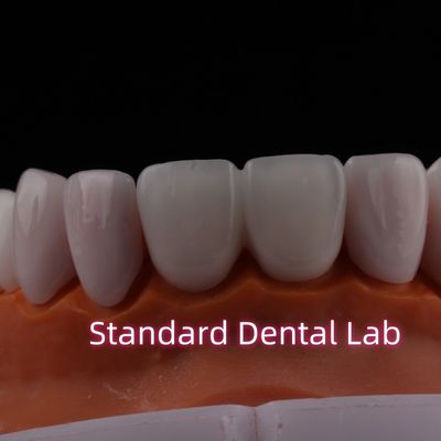 kupować Przejrzystość Emax Zirconia Laminate Veneers Porcelana Dental Veneers Chemicznie Stabilny produkcja internetowa
