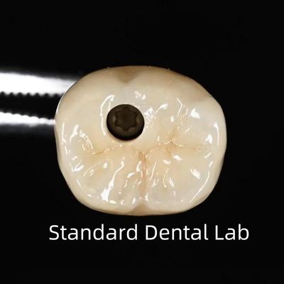 kupować Korona implantów dentystycznych z zaciskiem produkcja internetowa