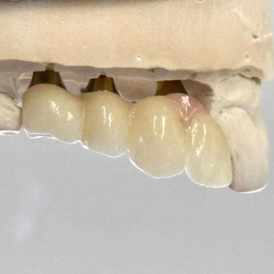 kupować Porcelan Zirkonia Cement Implant z zainstalowaną śrubą W kształcie sześciokątnej głowy dla estetyki dostosowanej do potrzeb produkcja internetowa