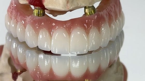 kupować Stomatologiczny wszelkie na X Implant PFM Korona tytanowa stała hybrydowa proteza produkcja internetowa