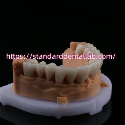 kupować FDA Wysoka estetyka Zębowa Zirkonia most z warstwami z porcelany Zirkonia korony dentystycznej China Dental Lab produkcja internetowa