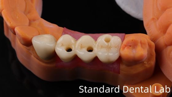 kupować Profesjonalne Zirkonia Implanty Stomatologiczne Korona Tytanium CAD CAM Zirkonia Korona China Dental Laboratory produkcja internetowa