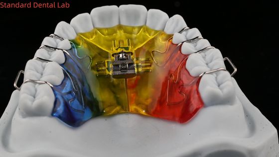 kupować Rozszerzenie i dystalizacja zębów Ortodontysta Rozszerzacz podniebienia China Dental Lab produkcja internetowa