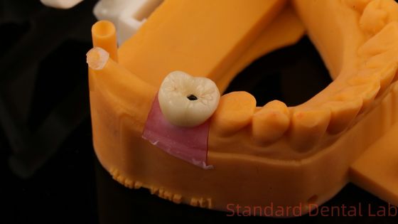 kupować Zębowe implanty śruby Korona PFZ Porcelana Zwierzchniowa Zirkonia Z Modelem Druku 3D produkcja internetowa