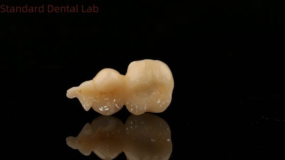 kupować Dental Digital Full Zirconia Crown With 3D Print Model SDL Dental Lab Zirconia Onlay produkcja internetowa