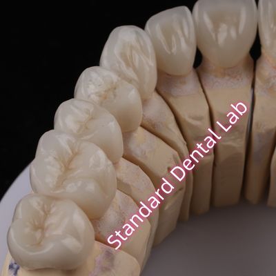 Cyfrowe CAD CAM Dental Lab PFZ Korony Przejrzystości Korona Zirkonia