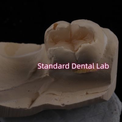 Odlewany porcelan zębowy Inlay Onlay Overlay Zirconia Emax Wysoka estetyka