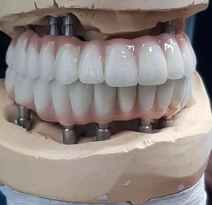 Precyzyjnie wykonany cyrkoniowy cement śrubkowy do implantów, zachowany do naturalnych zębów
