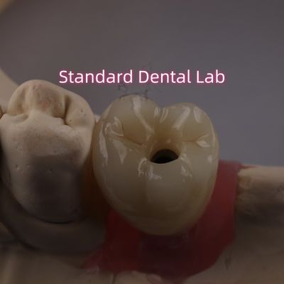 Korona implantu zębowego PFZ z porcelany z warstwą cyrkonia
