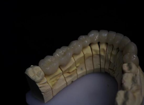 Porcelan złożony w warstwy, zirkonia stopiona