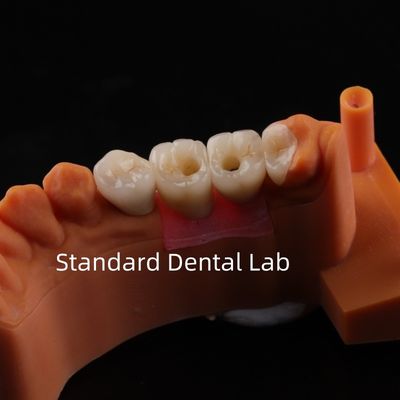 Porcelanowy most z implantami dentystycznymi z cyrkonii