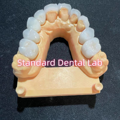 Wysoka estetyka Hollywood Smile Milling Emax Laminate Veneers