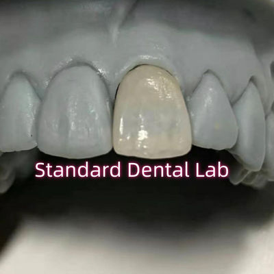 Stomatologia regeneracyjna Emax Korony z cyrkonii