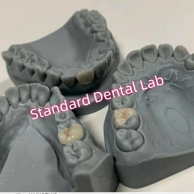 Kosmetyczne naturalnie wyglądające porcelany Inlay i Onlays Overlays