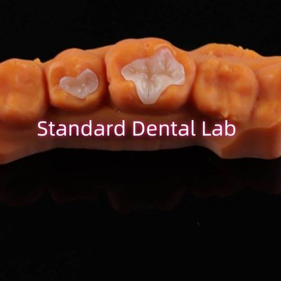 Zębowe porcelany Inlay Onlay Overlay Zirconia Emax Composite dla próchnicy zębów