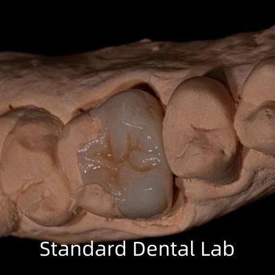 Przezroczystość Emax Zirconia Dental Inlay Onlay Crown For Restore Natural Cavity Shape
