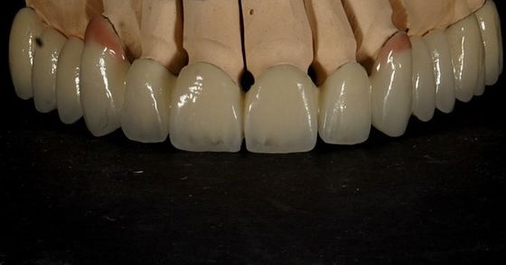 Dobre dopasowanie Dobre estetyczne wielowarstwowe zirkonia korona porcelana zirkonia most