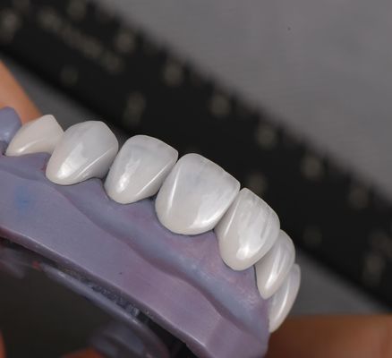Naturalnie wyglądający emax veneers korona biokompatybilność odcień wybielający z minimalnym przygotowaniem