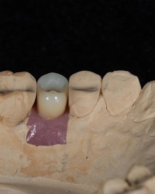 Implant z cementem śrubowym do długotrwałych implantów z 5-letnią gwarancją