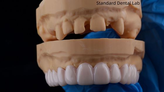 Wysoka estetyka zębowa Snap On Smile Standardowy zębowy laboratorium zdejmowalny urządzenie stomatologiczne