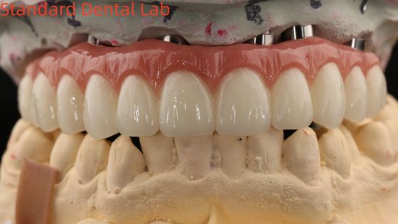 Porcelana All On Four Zirkonia Bridge Wysoka estetyka Implant zębowy