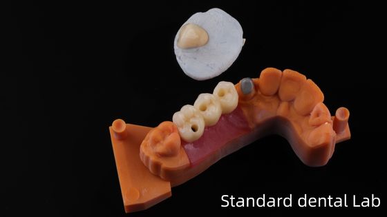 Laboratorium dentystyczne Post Core z Chin / Metal Post Core z koroną PFM