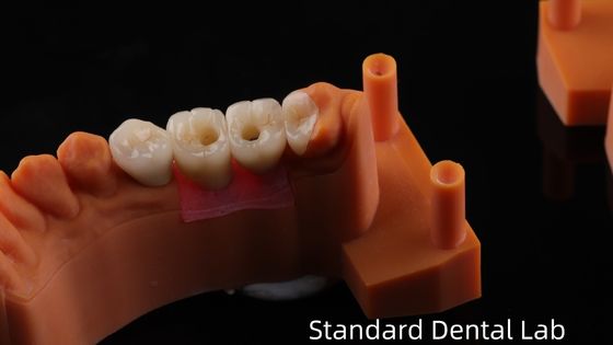 Korona implantów dentystycznych ze śrubą z PFZ Porcelany Zwarstwione Zirkonia 5-letnia gwarancja i model druku 3D