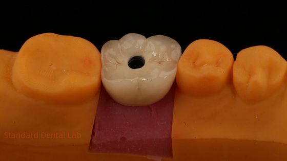 Śruby utrzymane PFZ Porcelany z warstwą Zirconia Korona implantu stomatologicznego z laboratorium stomatologicznego ISO FDA CE Certyfikowany z 5-letnią gwarancją