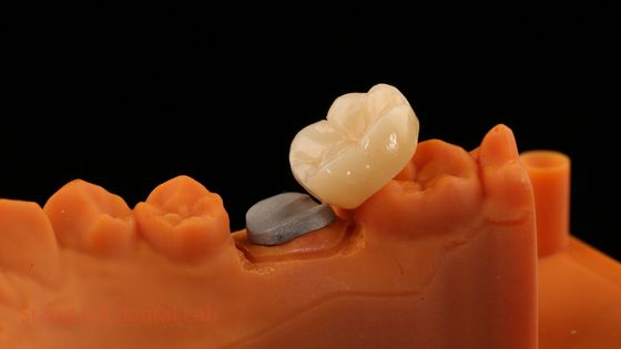 Wysoka estetyka, pełna kontur, zirkońska korona z metalowym rdzeniem, 5 lat gwarancji i lepszych techników z SDL Dental Lab.