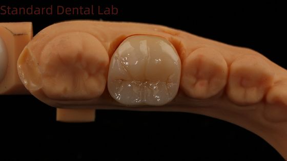 Dental Digital Full Zirconia Crown with Noritake Porcelan 3D Print Model 5 lat gwarancji