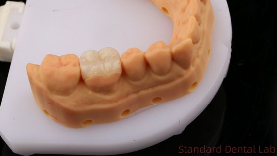 Przezroczystość Zirconia Dental Inlay Onlay Crown For Restore Natural Cavity Shape / Standardowe laboratorium stomatologiczne