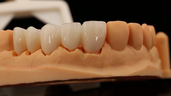 Wysokiej estetyki przednie zęby pełne kontur Zirconia korona z dostosowanymi Vita Shade Dental Lab