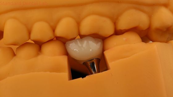 Korona implantów zwrotowych korona PFM z drukiem 3D