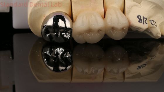 Vita Porcelanowa pełna korona metalowa z rdzeniem 3 lata gwarancja od dentysty