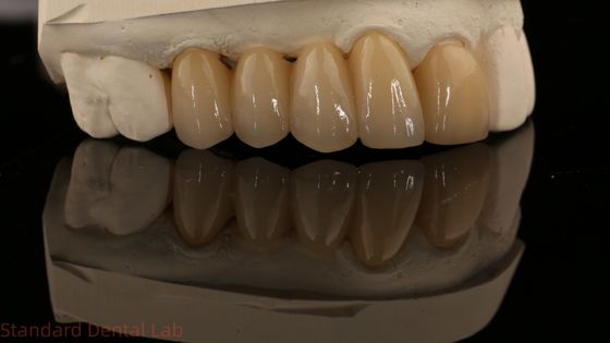 Noritake Porcelana pełny kontur Zirkonia Korona wysoka estetyczna naturalna niestandardowa Zirkonia most zębowy