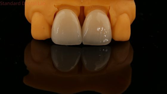 5 lat gwarancji pełny kontur Zirconia Crown Customized Vita Shade Wysoki estetyczny naturalny most zębowy