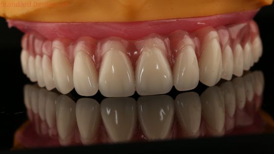 Akrylowy częściowy implant nad protezą Tyzaniowy pręt z pełną protezą Zęby ustawione