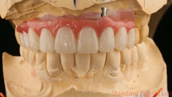 Dobrze pasujące Precyzyjne Estetyczne Zirkonia Porcelana Korona Różowa Porcelana Z Cieniem Błyszczącym