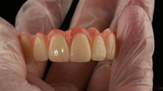 Porcelan All On Four Zirconia Bridge Wysoka estetyka most z implantami dentystycznymi