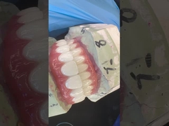 Korona implantów dentystycznych